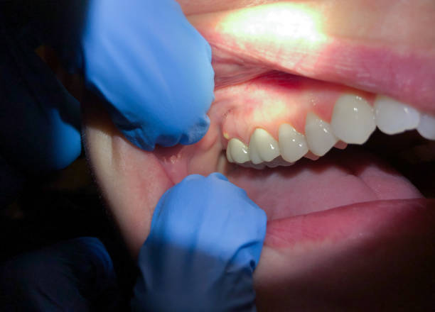 Best Dentist for Tooth Abscess  in Folsom, PA